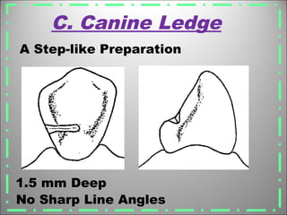 C. Canine Ledge
1.5 mm Deep
No Sharp Line Angles
A Step-like Preparation
 