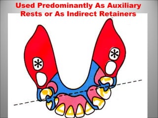 Used Predominantly As Auxiliary
Rests or As Indirect Retainers
 