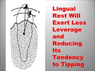Lingual
Rest Will
Exert Less
Leverage
and
Reducing
Its
Tendency
to Tipping
 