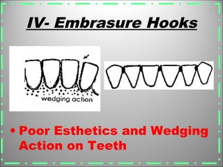 IV- Embrasure Hooks
• Poor Esthetics and Wedging
Action on Teeth
 