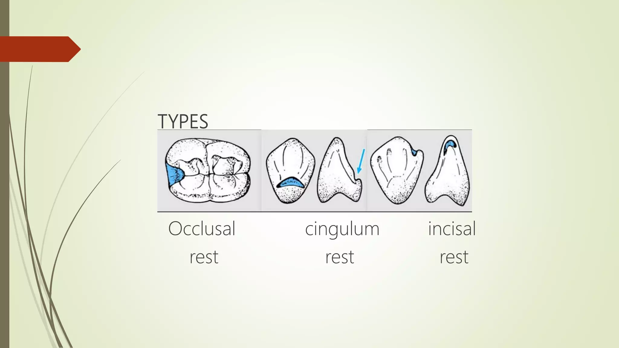 overview of occlusal rests and rest seats PPT