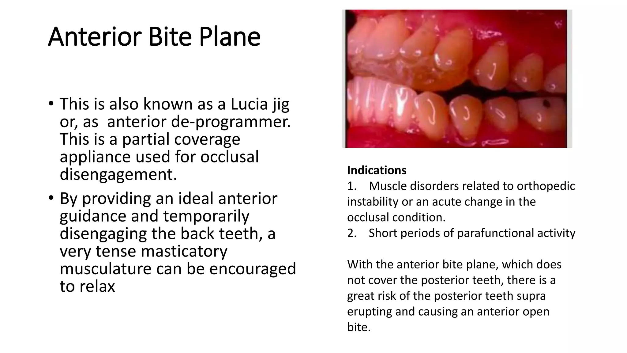 Occlusal splints | PPTX
