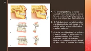 Maxillary Ramps Comprehensive Occlusal Splint Therapy for Temporomandibular Disorders ...