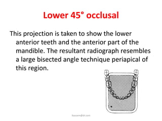 Lower 45° occlusal
This projection is taken to show the lower
  anterior teeth and the anterior part of the
  mandible. The resultant radiograph resembles
  a large bisected angle technique periapical of
  this region.




                     ikassem@dr.com
 