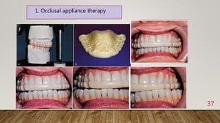 37
1. Occlusal appliance therapy
 