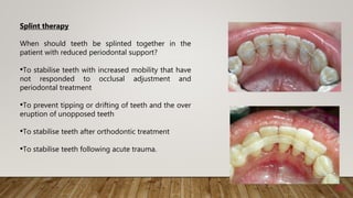 44
Splint therapy
When should teeth be splinted together in the
patient with reduced periodontal support?
•To stabilise teeth with increased mobility that have
not responded to occlusal adjustment and
periodontal treatment
•To prevent tipping or drifting of teeth and the over
eruption of unopposed teeth
•To stabilise teeth after orthodontic treatment
•To stabilise teeth following acute trauma.
 