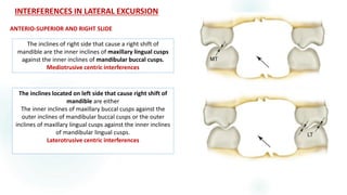 Lateral Excursion Interferences OCCLUSAL THERAPY IN FIXED PROSTHODONTICS | PDF