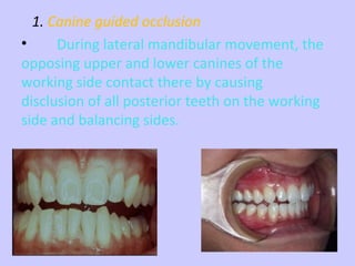 Occlusion | PPT