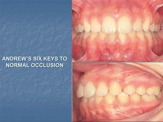ANDREW’S SIX KEYS TO
NORMAL OCCLUSION
 