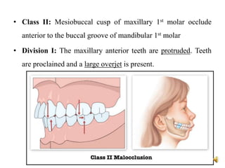 • Class II: Mesiobuccal cusp of maxillary 1st molar occlude
anterior to the buccal groove of mandibular 1st molar
• Division I: The maxillary anterior teeth are protruded. Teeth
are proclained and a large overjet is present.
 