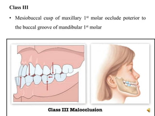 Class III
• Mesiobuccal cusp of maxillary 1st molar occlude poterior to
the buccal groove of mandibular 1st molar
 