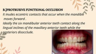 Tooth Disocclude Comprehensive Overview of Dental Occlusion: Concepts, Types, and ...
