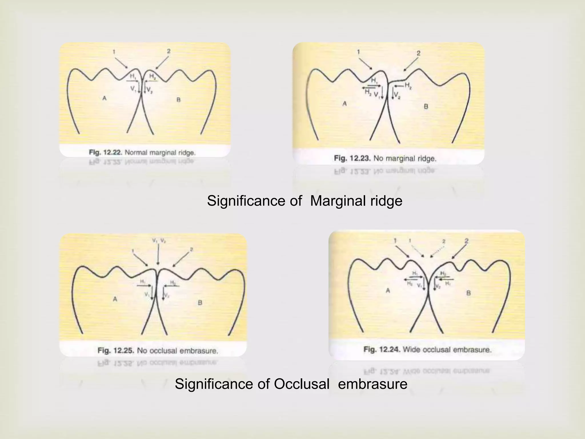 Marginal Ridges Leveling Occlusion in conservative dentistry | PPTX