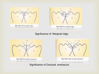 Occlusal Marginal Ridge Occlusion in conservative dentistry | PPTX