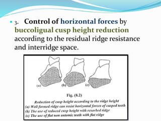  3. Control of horizontal forces by
buccoligual cusp height reduction
according to the residual ridge resistance
and interridge space.
 