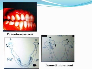 Protrusive movement
Bennett movement
 