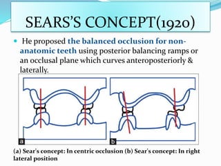 SEARS’S CONCEPT(1920)
 He proposed the balanced occlusion for non-
anatomic teeth using posterior balancing ramps or
an occlusal plane which curves anteroposteriorly &
laterally.
(a) Sear's concept: In centric occlusion (b) Sear's concept: In right
lateral position
 