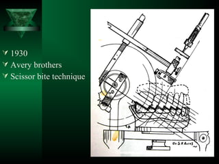  1930
 Avery brothers
 Scissor bite technique
 
