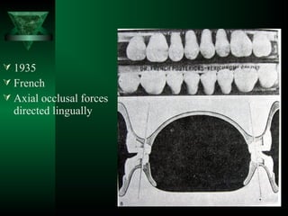 1935
 French
 Axial occlusal forces
directed lingually
 