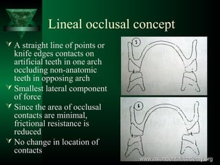 Lineal occlusal concept
 A straight line of points or
knife edges contacts on
artificial teeth in one arch
occluding non-anatomic
teeth in opposing arch
 Smallest lateral component
of force
 Since the area of occlusal
contacts are minimal,
frictional resistance is
reduced
 No change in location of
contacts
www.asiandentalacademy.orgwww.asiandentalacademy.org
 
