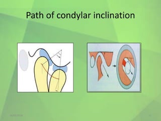Path Inclination OCCLUSION IN COMPLETE DENTURES.pptx