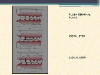 FLUSH TERMINAL
PLANE
DISTAL STEP
MESIAL STEP
 