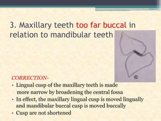 3. Maxillary teeth too far buccal in
relation to mandibular teeth
CORRECTION-
• Lingual cusp of the maxillary teeth is made
more narrow by broadening the central fossa
• In effect, the maxillary lingual cusp is moved lingually
and mandibular buccal cusp is moved buccally
• Cusp are not shortened
 