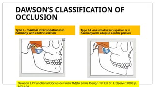 DAWSON’S CLASSIFICATION OF
OCCLUSION
Type I – maximal intercuspation is in
harmony with centric relation
Type I A - maximal intercuspation is in
harmony with adapted centric posture
Dawson E.P Functional Occlusion From TMJ to Smile Design 1st Ed. St. L Elseiver;2009.p.
 