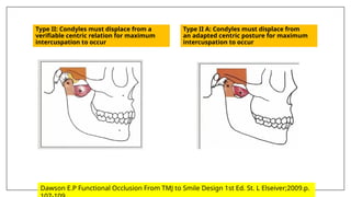 Type II: Condyles must displace from a
verifiable centric relation for maximum
intercuspation to occur
Type II A: Condyles must displace from
an adapted centric posture for maximum
intercuspation to occur
Dawson E.P Functional Occlusion From TMJ to Smile Design 1st Ed. St. L Elseiver;2009.p.
 