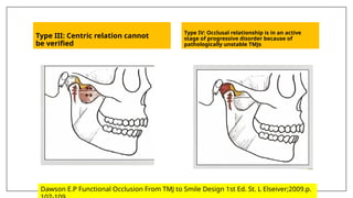 Type III: Centric relation cannot
be verified
Type IV: Occlusal relationship is in an active
stage of progressive disorder because of
pathologically unstable TMJs
Dawson E.P Functional Occlusion From TMJ to Smile Design 1st Ed. St. L Elseiver;2009.p.
 