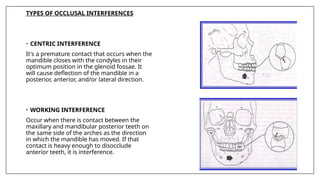 TYPES OF OCCLUSAL INTERFERENCES
• CENTRIC INTERFERENCE
It's a premature contact that occurs when the
mandible closes with the condyles in their
optimum position in the glenoid fossae. It
will cause deflection of the mandible in a
posterior, anterior, and/or lateral direction.
• WORKING INTERFERENCE
Occur when there is contact between the
maxillary and mandibular posterior teeth on
the same side of the arches as the direction
in which the mandible has moved. If that
contact is heavy enough to disocclude
anterior teeth, it is interference.
 