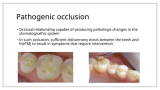 Pathogenic occlusion
• Occlusal relationship capable of producing pathologic changes in the
stomatognathic system
• In such occlusion, sufficient disharmony exists between the teeth and
theTMJ to result in symptoms that require intervention
 