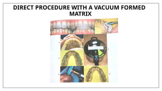 DIRECT PROCEDURE WITH A VACUUM FORMED
MATRIX
 