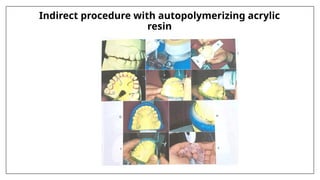 Indirect procedure with autopolymerizing acrylic
resin
 