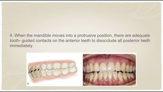 Tooth Disocclude Occlusion in fixed partial denture | PPTX | Dental Health | Diseases ...