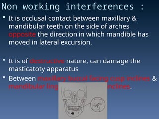 Lateral Excursion Interferences occlusion in fixed partial denture in dentistry | PPT