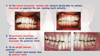 4. In the lateral excursions, working side contacts (preferably on canines)
disocclude or separate the non- working teeth instantly.
5. In protrusive excursions,
anterior tooth contacts will
disocclude the posterior teeth.
6. In an upright posture,
posterior
teeth contact more heavily than
do anterior teeth.
 