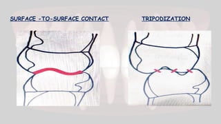SURFACE -TO-SURFACE CONTACT TRIPODIZATION
 
