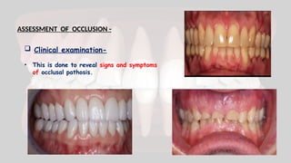 ASSESSMENT OF OCCLUSION -
 Clinical examination-
• This is done to reveal signs and symptoms
of occlusal pathosis.
 
