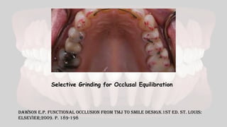 Dawson E.P. Functional Occlusion From TMJ To Smile Design.1st Ed. St. Louis:
Elsevier;2009. p. 189-198
Selective Grinding for Occlusal Equilibration
 