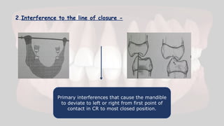 2.Interference to the line of closure -
Primary interferences that cause the mandible
to deviate to left or right from first point of
contact in CR to most closed position.
 