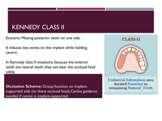 Comprehensive Guide to Occlusion in Single and Partially Edentulous ...