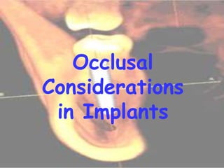 Occlusal
Considerations
in Implants
 