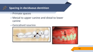 Spacing in deciduous dentition
▰Primate spaces
▰Mesial to upper canine and distal to lower
canine
▰Genralised spacing
13
 