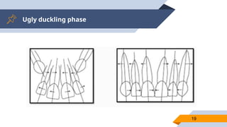 Ugly duckling phase
19
 