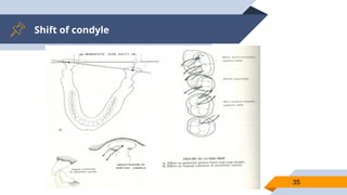 Shift of condyle
35
 
