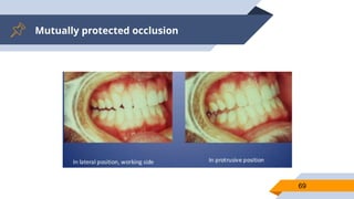 Mutually protected occlusion
69
 