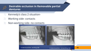 Desirable occlusion in Removable partial
dentures
85
1) Kennedy’s class 2 situation-
2) Working side- contacts
3) Non-working side- no contacts
 