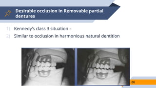 Desirable occlusion in Removable partial
dentures
86
1) Kennedy’s class 3 situation –
2) Similar to occlusion in harmonious natural dentition
 