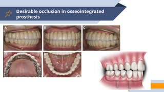 Desirable occlusion in osseointegrated
prosthesis
91
 